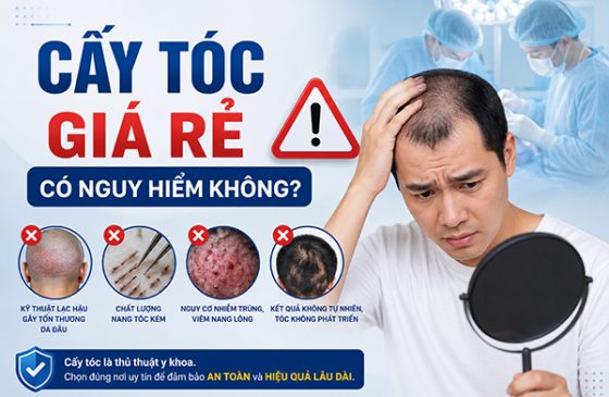 Cấy tóc giá rẻ có nguy hiểm không? Cảnh báo 6 rủi ro nghiêm trọng