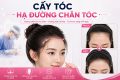Cấy tóc hạ đường chân tóc: Giải pháp điều chỉnh đường chân tóc tự nhiên