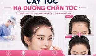 Cấy tóc hạ đường chân tóc: Giải pháp điều chỉnh đường chân tóc tự nhiên