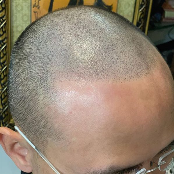 Xăm chân tóc có giải quyết được tình trạng hói đầu không?