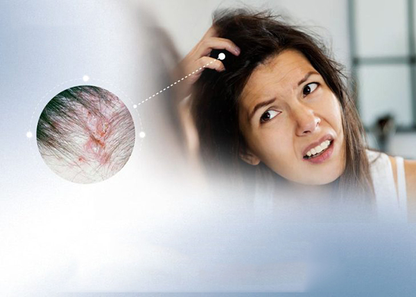 [Giải đáp] Rụng tóc do nấm có mọc lại không