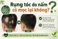 [Giải đáp] Rụng tóc do nấm có mọc lại không