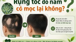[Giải đáp]: Rụng tóc do nấm có mọc lại không?