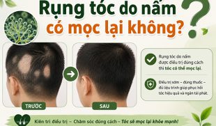 [Giải đáp]: Rụng tóc do nấm có mọc lại không?