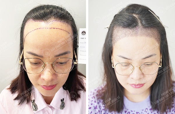 Khách hàng được bác sĩ vương thực hiện cấy tóc hạ trán cao