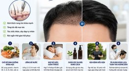 Cách giúp tóc cấy nhanh mọc theo hướng dẫn của bác sĩ