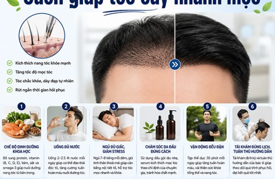 Cách giúp tóc cấy nhanh mọc