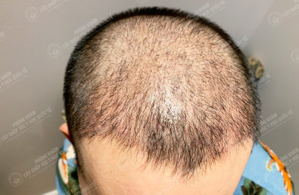 cấy tóc 1 tháng chưa mọc có sao không