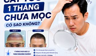 [Tìm hiểu]: Cấy tóc 1 tháng chưa mọc có sao không?