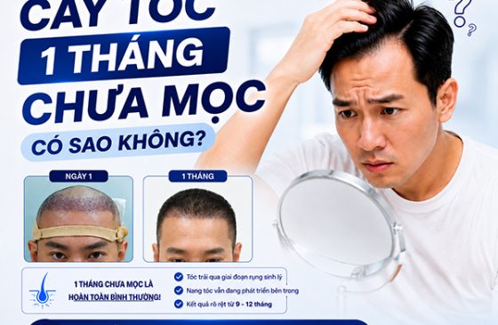 cấy tóc 1 tháng chưa mọc có sao không