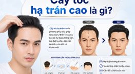 Cấy tóc hạ trán cao là gì? 8 Điều cần biết trước khi lựa chọn