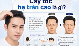 Cấy tóc hạ trán cao là gì? 8 Điều cần biết trước khi lựa chọn