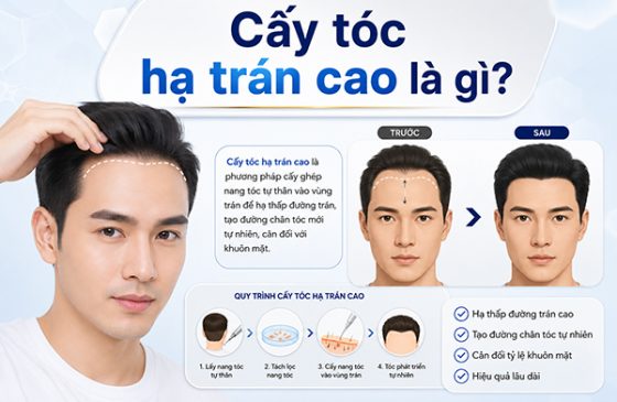 Cấy tóc hạ trán cao là gì? 8 Điều cần biết trước khi lựa chọn