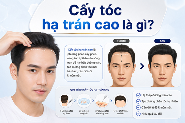 Cấy tóc hạ trán cao là gì? 8 Điều cần biết trước khi lựa chọn