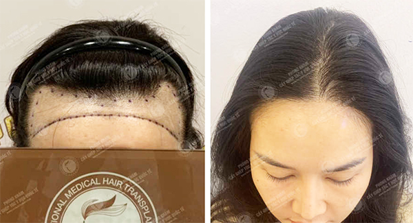 khách hàng được bác sĩ vương cấy tóc hạ trán cao thành công
