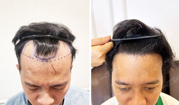khách hàng được bác sĩ vương cấy tóc xóa hói chữ m thành công