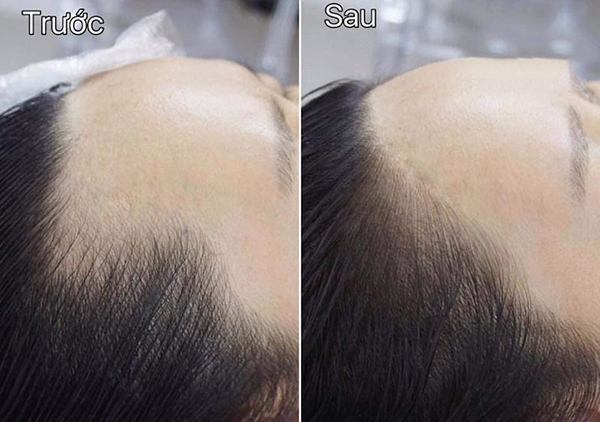 Xăm chân tóc có thực sự giúp tóc trông dày hơn không?