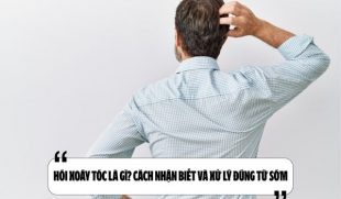 Hói xoáy tóc là gì? Cách nhận biết và xử lý đúng từ sớm