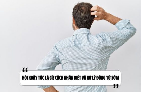 Hói xoáy tóc là gì? Cách nhận biết và xử lý đúng từ sớm
