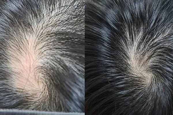 Hói xoáy tóc là gì? Cách nhận biết và xử lý đúng từ sớm