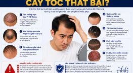 Như thế nào là cấy tóc thất bại? 7 dấu hiệu cảnh báo không nên chủ quan