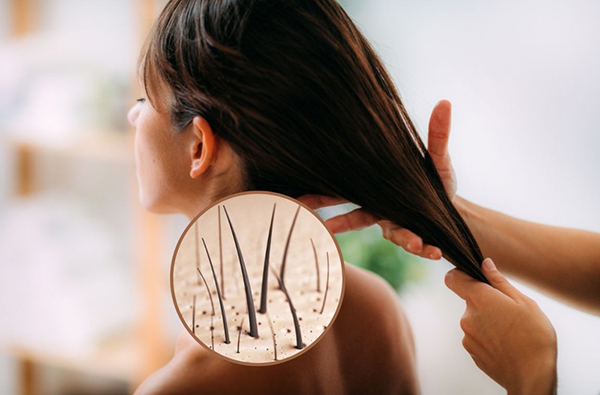 Cấy tóc thất bai do Chăm sóc sau cấy không đúng hướng dẫn