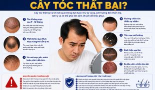 Như thế nào là cấy tóc thất bại? 7 dấu hiệu cảnh báo không nên chủ quan