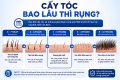 Cấy tóc bao lâu thì rụng? Hiểu đúng về giai đoạn hồi phục sau cấy tóc