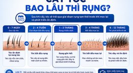 Cấy tóc bao lâu thì rụng? Hiểu đúng về giai đoạn hồi phục sau cấy tóc