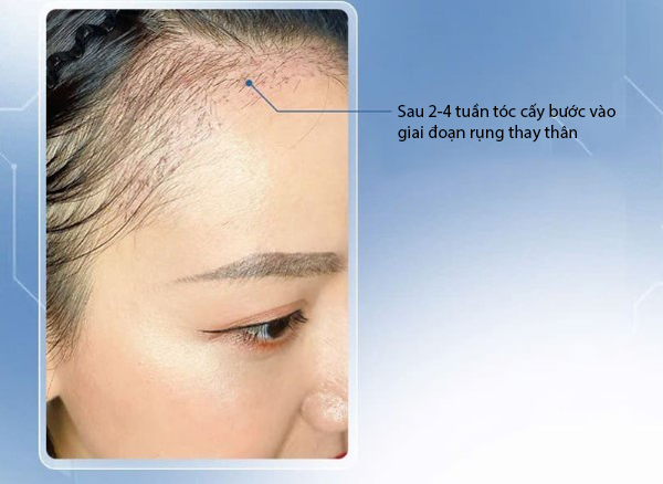 Vì sao tóc cấy lại rụng sau khi cấy?