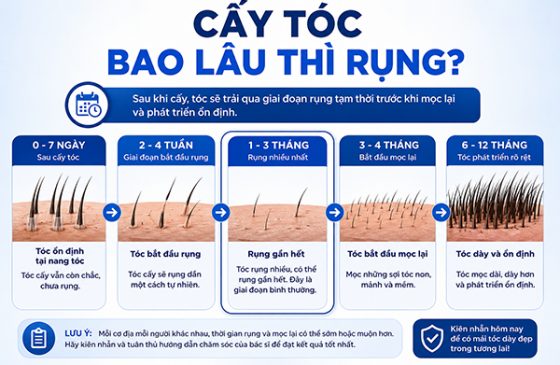Cấy tóc bao lâu thì rụng? Hiểu đúng về giai đoạn hồi phục sau cấy tóc