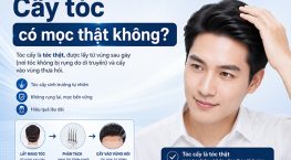 Cấy tóc có mọc thật không? Sự thật nên biết