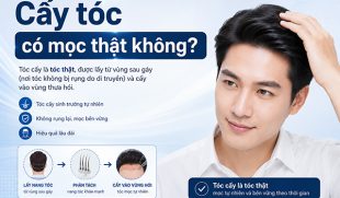 Cấy tóc có mọc thật không? Sự thật nên biết