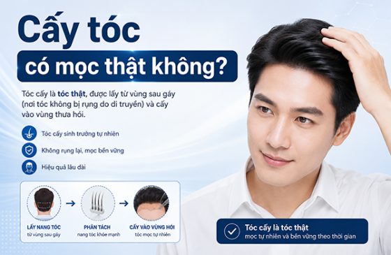 Cấy tóc có mọc thật không?