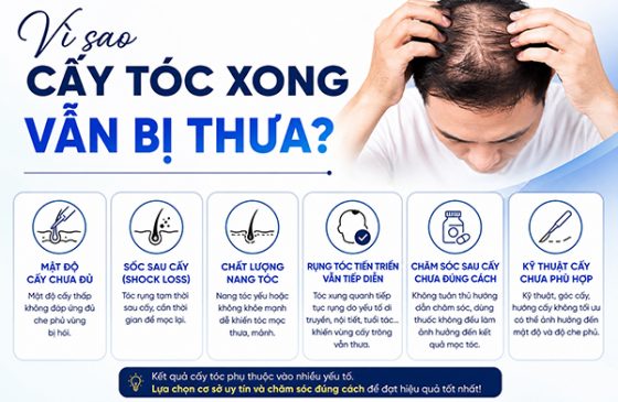 Vì sao cấy tóc xong vẫn bị thưa? 6 nguyên nhân nên biết