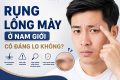 Rụng lông mày ở nam giới có đáng lo không?