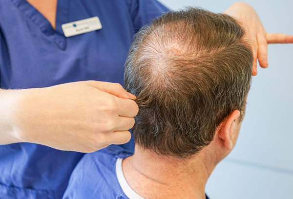 Vùng cho tóc không đủ điều kiện để thực hiện cấy ghép