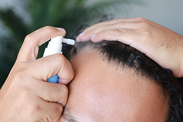 Minoxidil có gây vô sinh không