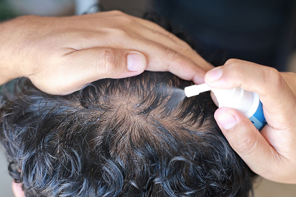 Vì sao ngừng Minoxidil lại khiến tóc rụng trở lại?