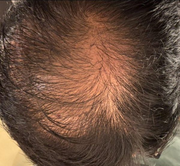 nguyên nhân khiến tóc sau cấy vẫn bị thưa
