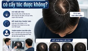[Giải đáp]: Sẹo da đầu có cấy tóc được không?