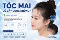 Tóc mai có cấy được không? Những điều cần biết trước khi thực hiện
