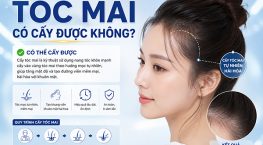 Tóc mai có cấy được không? Những điều cần biết trước khi thực hiện