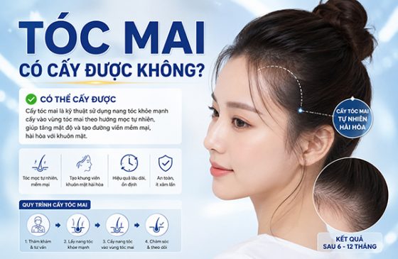 Tóc mai có cấy được không? Những điều cần biết trước khi thực hiện