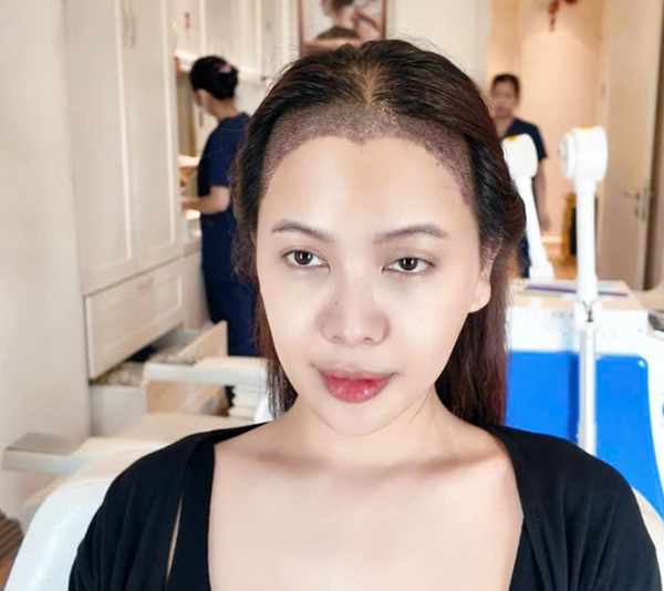kết quả sau 4 ngày cấy tóc trên sẹo sau phẫu thuật hạ đường chân tóc