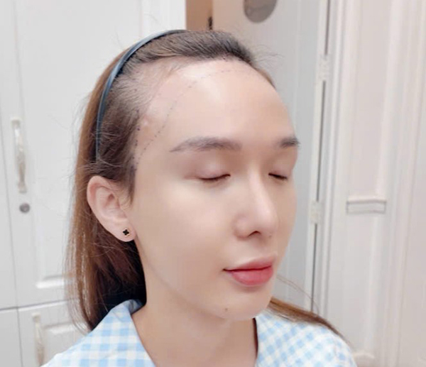 Đối tượng có thể cấy tóc trên sẹo
