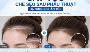 [Tìm Hiểu]: Cấy tóc che sẹo sau phẫu thuật hạ đường chân tóc
