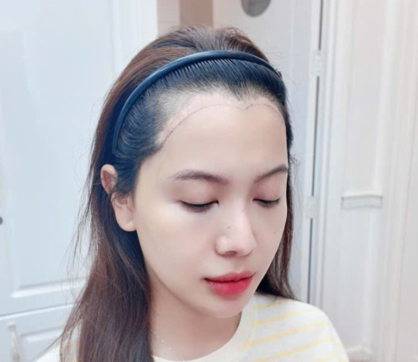 Cấy tóc che sẹo sau phẫu thuật hạ đường chân tóc là phương pháp sử dụng nang tóc tự thân để che phủ vùng sẹo, giúp cải thiện mật độ tóc và tạo đường chân tóc tự nhiên hơn