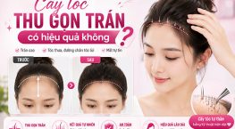 [Tìm Hiểu] : Cấy tóc thu gọn trán có hiệu quả không?