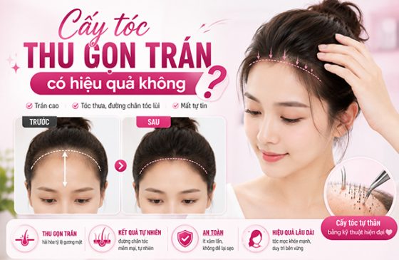 [Tìm Hiểu] : Cấy tóc thu gọn trán có hiệu quả không?